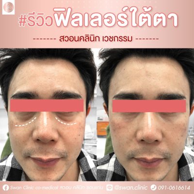 ฟิลเลอร์ใต้ตา