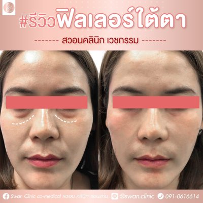 ฟิลเลอร์ใต้ตา