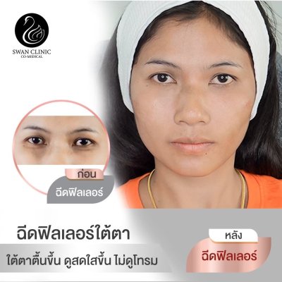 ฟิลเลอร์ใต้ตา