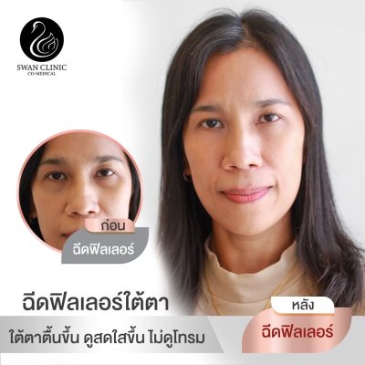 ฟิลเลอร์ใต้ตา