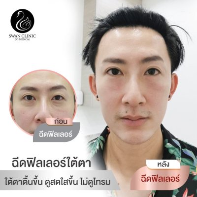 ฟิลเลอร์ใต้ตา