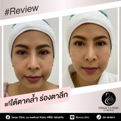 ฟิลเลอร์ใต้ตา