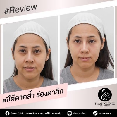 ฟิลเลอร์ใต้ตา
