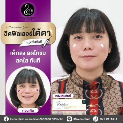 ฟิลเลอร์ใต้ตา
