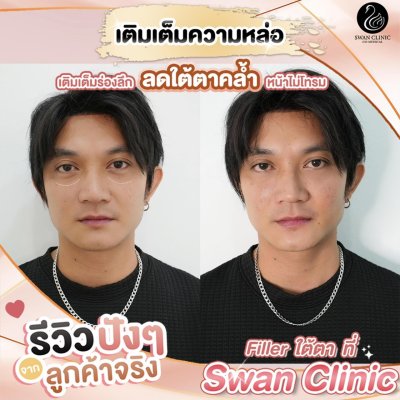 ฟิลเลอร์ใต้ตา