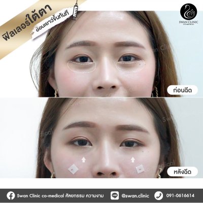 ฟิลเลอร์ใต้ตา