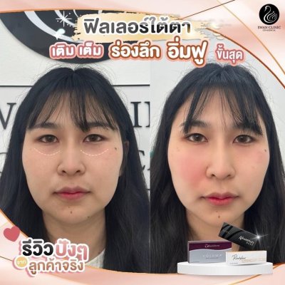 ฟิลเลอร์ใต้ตา