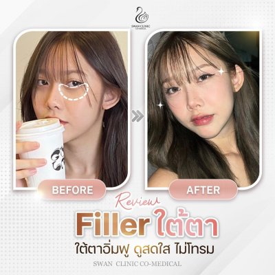 ฟิลเลอร์ใต้ตา