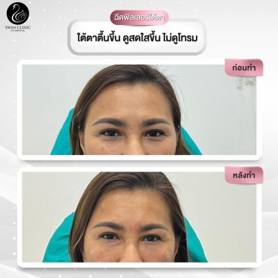 ฟิลเลอร์ใต้ตา