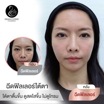 ฟิลเลอร์ใต้ตา