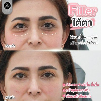 ฟิลเลอร์ใต้ตา