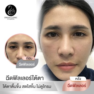 ฟิลเลอร์ใต้ตา