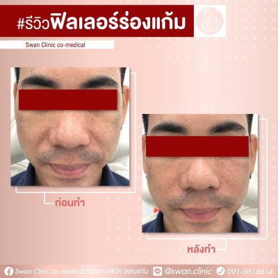 ฟิลเลอร์ร่องแก้ม