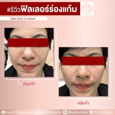 ฟิลเลอร์ร่องแก้ม