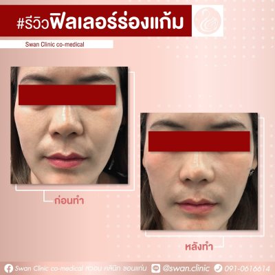ฟิลเลอร์ร่องแก้ม