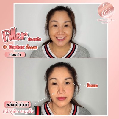 รีวิวฟิลเลอร์ร่องแก้ม