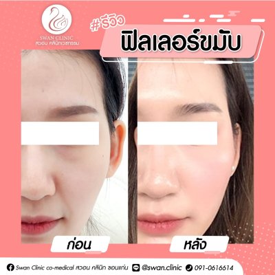 ฟิลเลอร์ขมับ