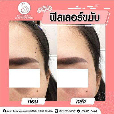 รีวิวฟิลเลอร์ขมับ
