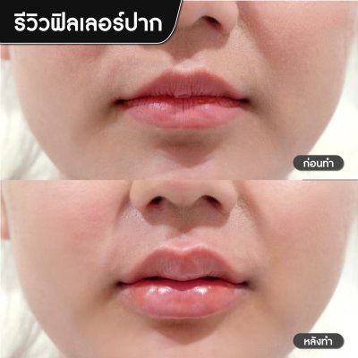 ฟิลเลอร์ปาก