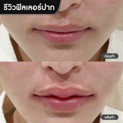 ฟิลเลอร์ปาก