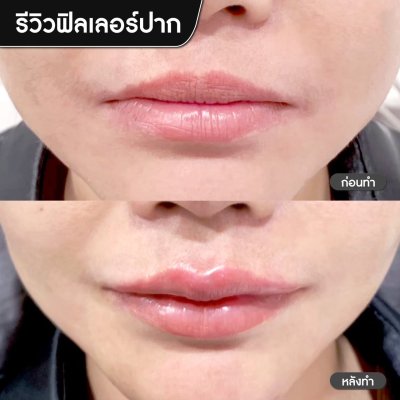 ฟิลเลอร์ปาก