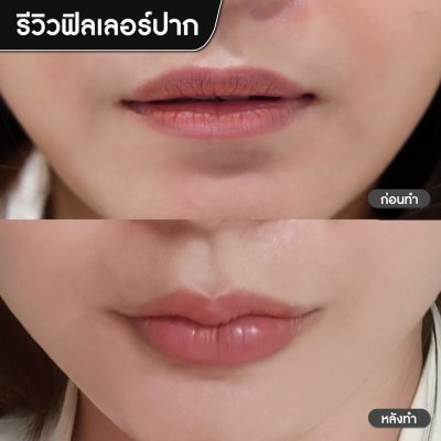 ฟิลเลอร์ปาก