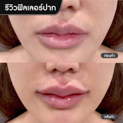 ฟิลเลอร์ปาก