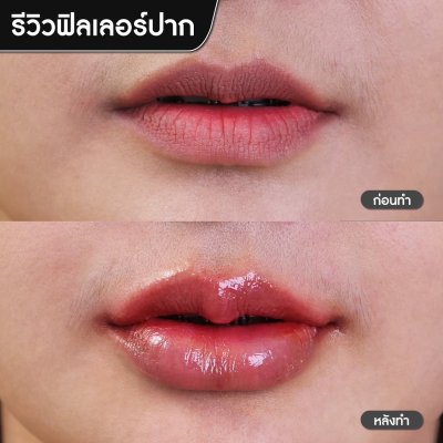ฟิลเลอร์ปาก