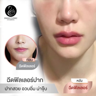 ฟิลเลอร์ปาก