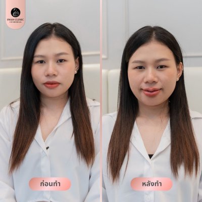 ฟิลเลอร์ปาก