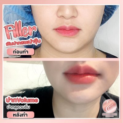 รีวิวฟิลเลอร์ปาก