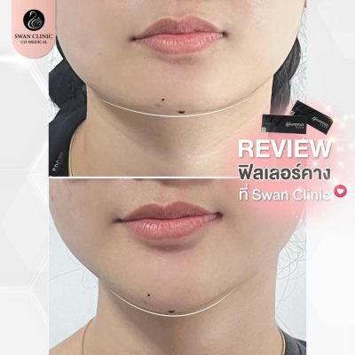 ฟิลเลอร์คาง