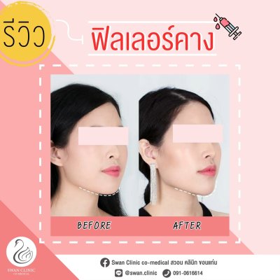 ฟิลเลอร์คาง