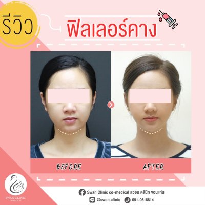 ฟิลเลอร์คาง