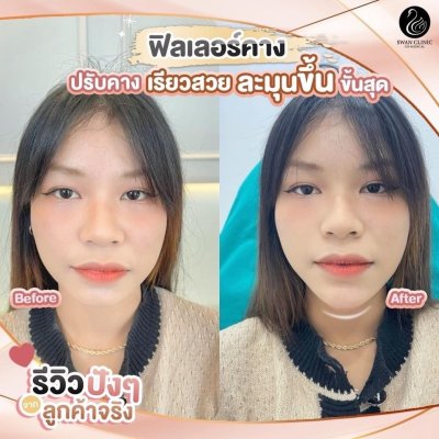 ฟิลเลอร์คาง