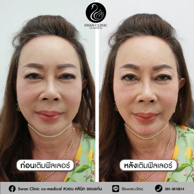 ฟิลเลอร์คาง