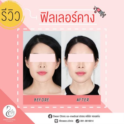 รีวิวฟิลเลอร์คาง