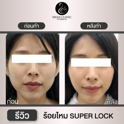 ร้อยไหม Super Lock