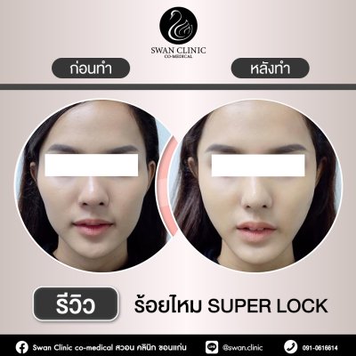 ร้อยไหม Super Lock