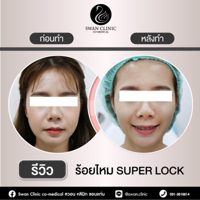 ร้อยไหม Super Lock