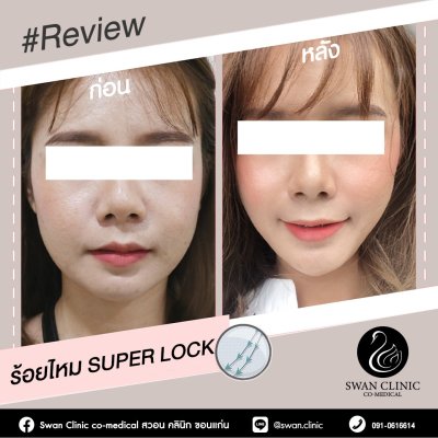 ร้อยไหม Super Lock