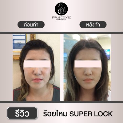 ร้อยไหม Super Lock