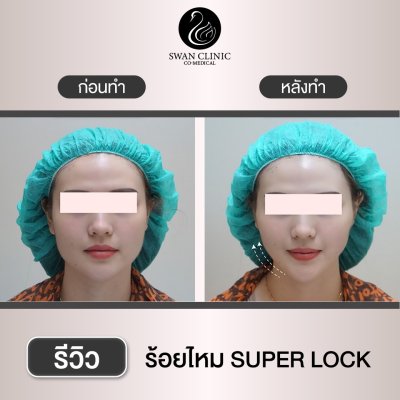 รีวิวร้อยไหม Super Lock