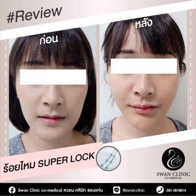 ร้อยไหม Super Lock