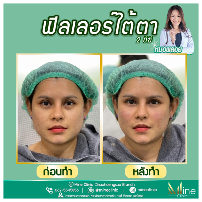 รีวิว ฟิลเลอร์ ใต้ตา มายน์คลินิก