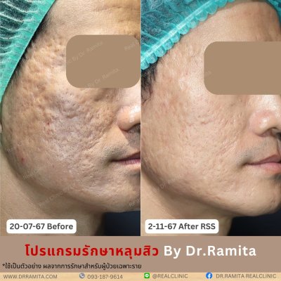 juvgen drjin ดร.จิน หลุมสิวเกาหลี รักษาหลุมสิว ศัลยกรรมหลุมสิว real scar synergy dr ramita รีวิวหลุมสิว