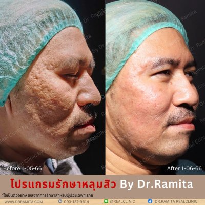 รักษาหลุมสิว,ตัดพังผืด,รักษาหลุมสิว, วิธีรักษาหลุมสิว, Fractional Laser, Microneedling, Subcision, เติมฟิลเลอร์, Real Scar Synergy, Juvgen,acnescarsurgery,acnescarrevision,รักษาหลุมสิวให้ตื้น,เลเซอร์หลุมสิว, รักษาหลุมสิวที่ดีที่สุด,รักษาหลุมสิวให้หายขาด,ห
