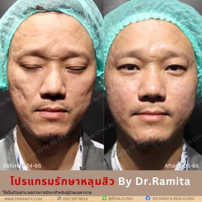 ฟิลเลอร์หลุมสิว ฉีดฟิลเลอร์หลุมสิว fillerหลุมสิว เติมเต็มหลุมสิว ดรจินหลุมสิว หลุมสิวเกาหลี