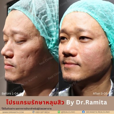 รักษาหลุมสิว,ตัดพังผืด,รักษาหลุมสิว, วิธีรักษาหลุมสิว, Fractional Laser, Microneedling, Subcision, เติมฟิลเลอร์, Real Scar Synergy, Juvgen,acnescarsurgery,acnescarrevision,รักษาหลุมสิวให้ตื้น,เลเซอร์หลุมสิว, รักษาหลุมสิวที่ดีที่สุด,รักษาหลุมสิวให้หายขาด,ห
