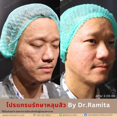 juvgen drjin ดร.จิน หลุมสิวเกาหลี รักษาหลุมสิว ศัลยกรรมหลุมสิว real scar synergy dr ramita 